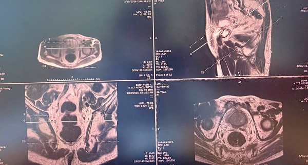 Ứng dụng kỹ thuật sinh thiết đích qua tầng sinh môn, bệnh nhân ung thư tiền liệt tuyến được can thiệp kịp thời, điều trị ổn định